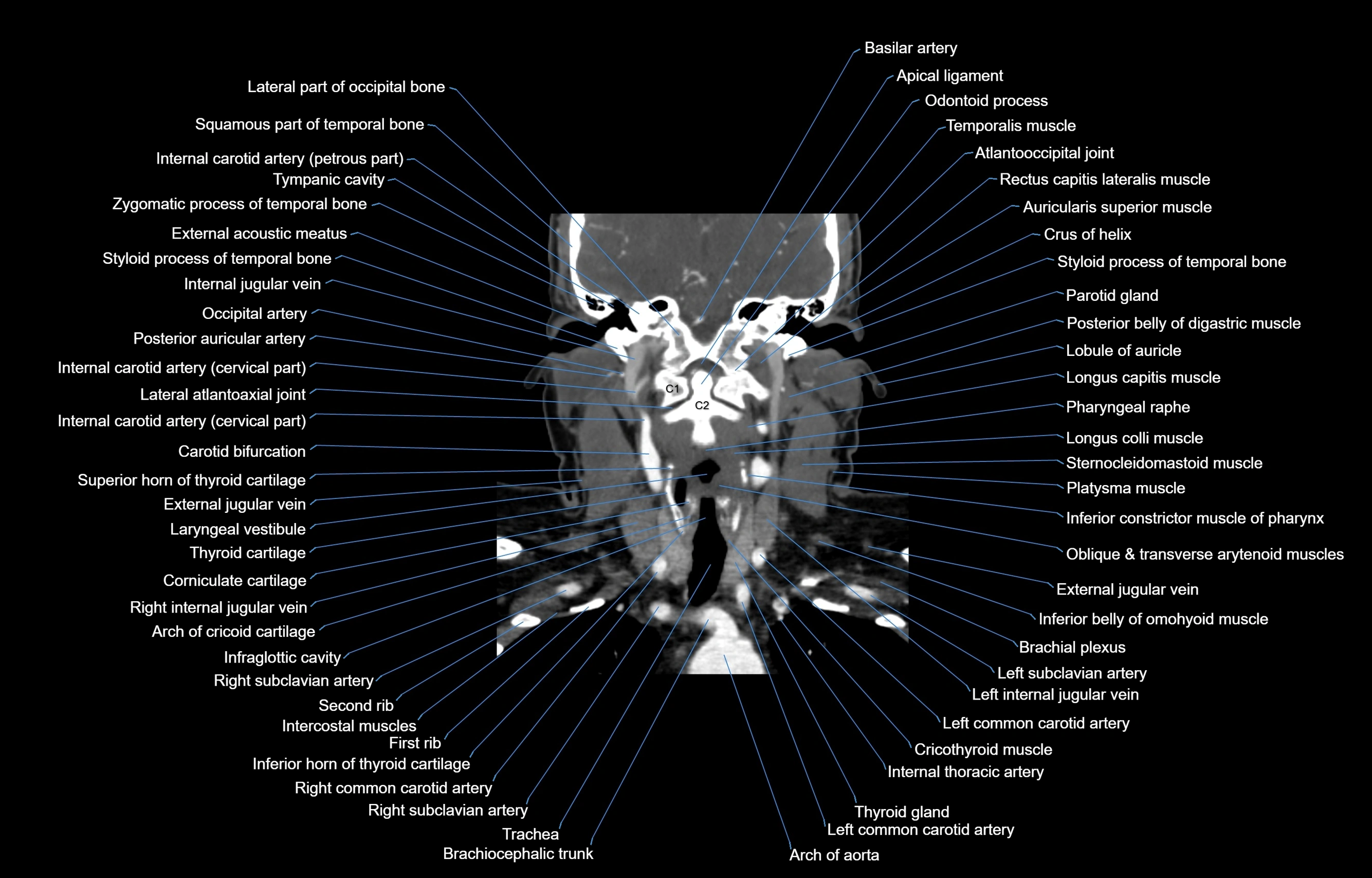 CT Neck coronal  cross sectional anatomy labelled 3D  radiology  image-00037.webp